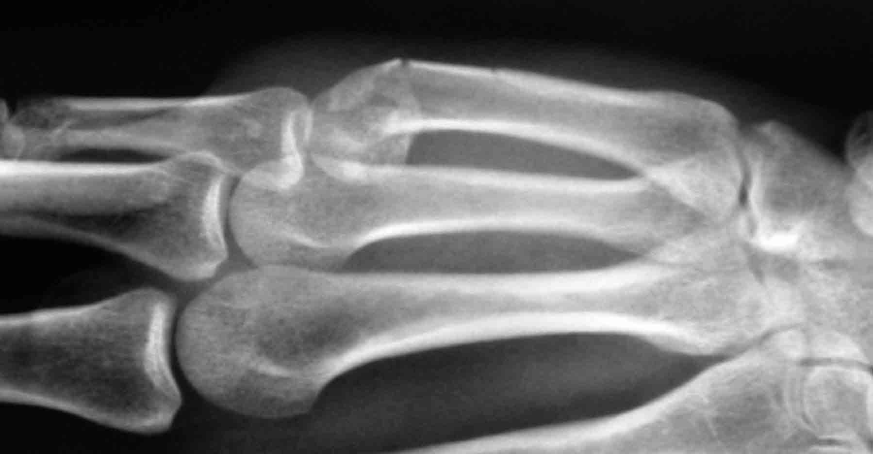 Common hand fractures